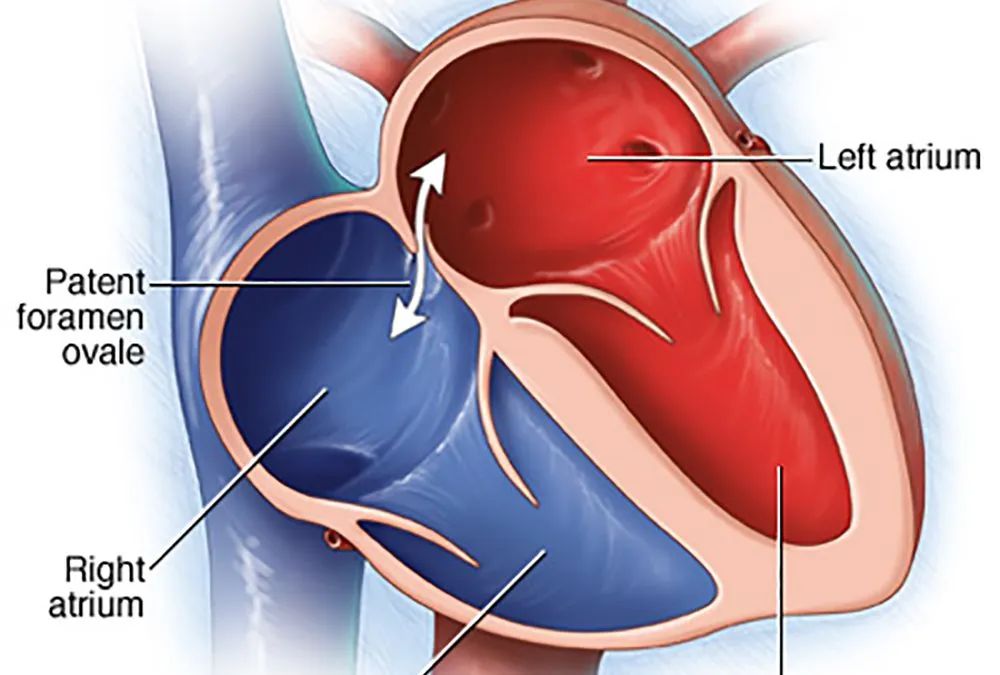 金年会体育總院心内科獨立完成全市首例經皮卵圓孔未閉封堵手術
